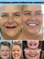Full Denture Set